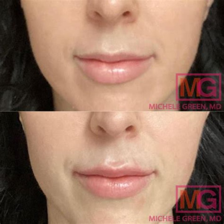 Ines Helene Before Plastic Surgery | Botox And Lip Filler