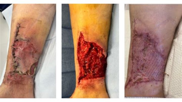 
What exactly are thermal wounds? Days after a catastrophic vehicle crash, Anne Heche’s cause of death was made public. 