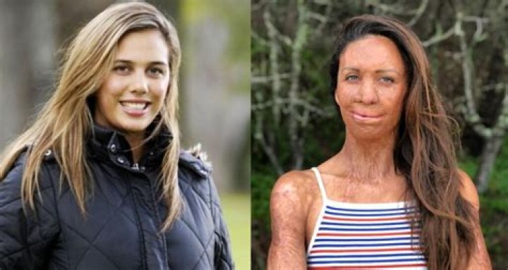 
What Happened To Turia Pitt? Accident Details And Before Photos – How Did She Get Burnt? 